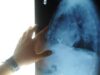 Radiologia interventistica, Ssn e fondazioni per cure più accessibili