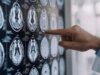 Stop tremori Parkinson senza bisturi, 10 pazienti curati con ultrasuoni a Napoli
