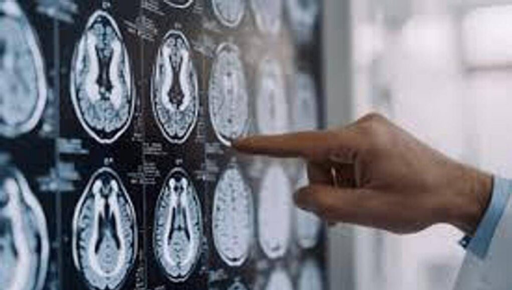 Stop tremori Parkinson senza bisturi, 10 pazienti curati con ultrasuoni a Napoli