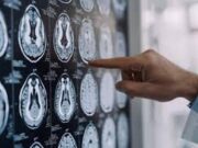 Stop tremori Parkinson senza bisturi, 10 pazienti curati con ultrasuoni a Napoli