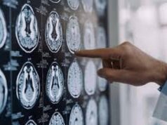 Stop tremori Parkinson senza bisturi, 10 pazienti curati con ultrasuoni a Napoli